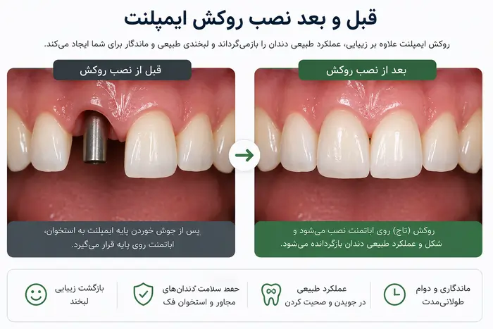 روکش ایمپلنت