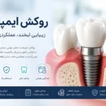 روکش ایمپلنت