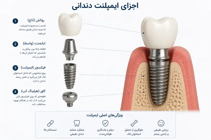 اجزای ایمپلنت دندان