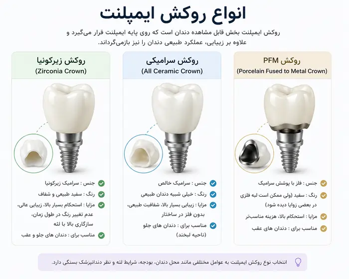 انواع روکش ایمپلنت