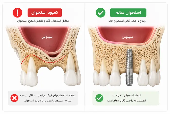 نیاز به سینوس لیفت و پیوند استخوان