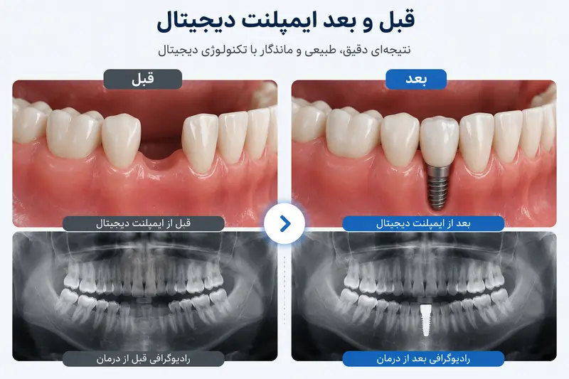 ایمپلنت دیجیتال چیست؟ مزایا، مراحل، هزینه و ماندگاری در ۱۴۰۵ 6 نمونه قبل و بعد ایمپلنت دیجیتال