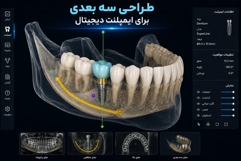ایمپلنت دیجیتال چیست؟ مزایا، مراحل، هزینه و ماندگاری در ۱۴۰۵ 5 طراحی سه بعدی برای کاشت ایمپلنت دیجیتال