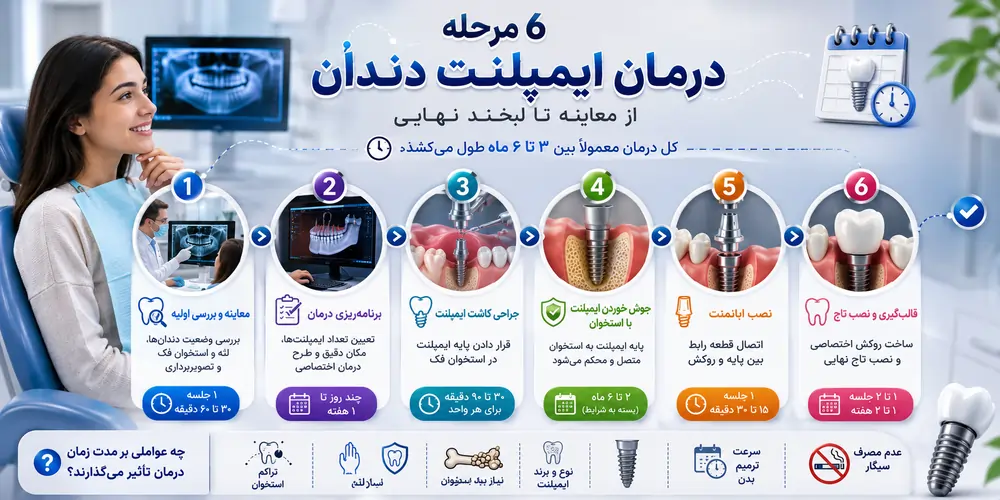 درمان ایمپلنت چقدر طول می کشد؟ بررسی مراحل، مدت زمان و عوامل موثر در 1405 1 درمان ایمپلنت دندان چقدر طول می کشد