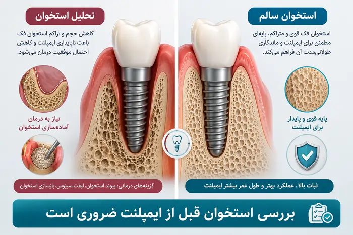 تأثیر تحلیل استخوان فک و پوکی استخوان بر انجام ایمپلنت دندان