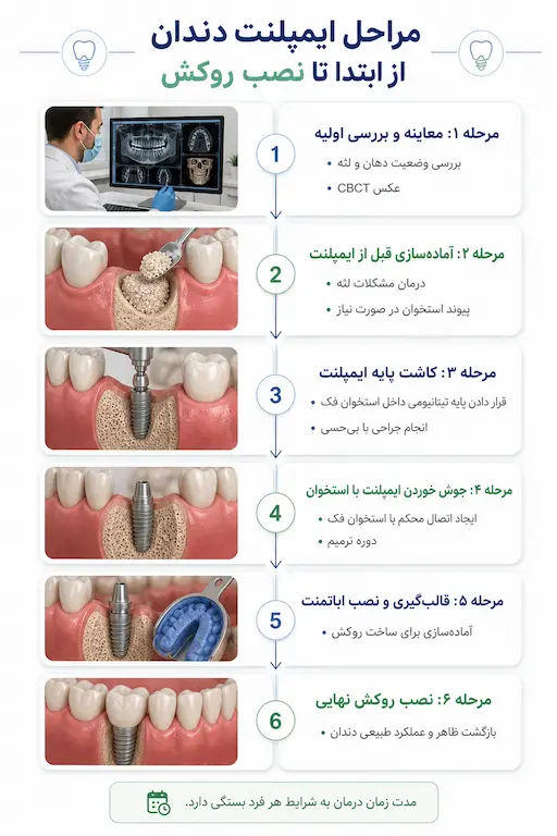 مراحل ایمپلنت دندان از ابتدا تا نصب روکش 6 اینفوگرافیک مراحل ایمپلنت دندان از ابتدا تا نصب روکش