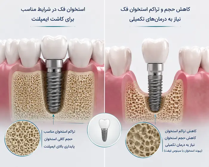 تاثیر وضعیت استخوان فک بر هزینه ایمپلنت