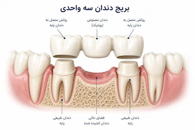نحوه قرار گرفتن بریج روی دندان های مجاور