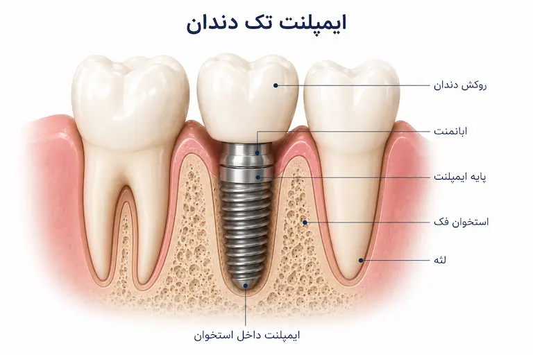 قرار گرفتن پایه ایمپلنت و روکش در استخوان فک