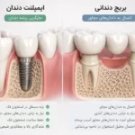 مقایسه ایمپلنت یا بریج برای جایگزینی دندان از دست رفته