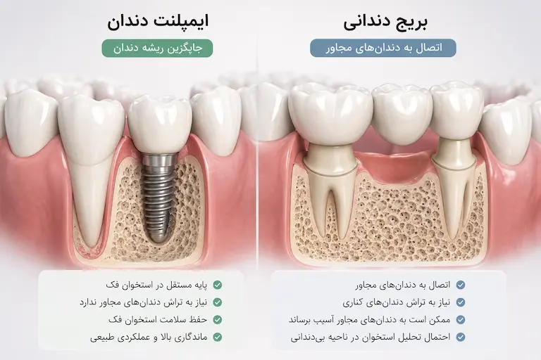 مقایسه ایمپلنت یا بریج برای جایگزینی دندان از دست رفته