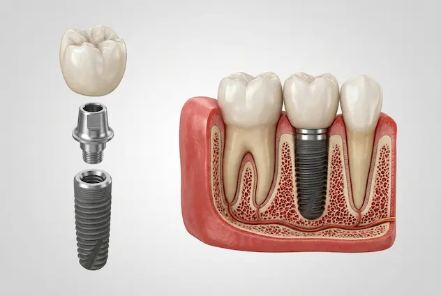 اجزای ایمپلنت دندان شامل پایه، اباتمنت و روکش