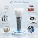 عوامل موثر بر هزینه کاشت دندان