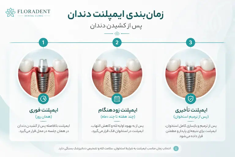 مراحل زمانی ایمپلنت بعد از کشیدن دندان از فوری تا تأخیری