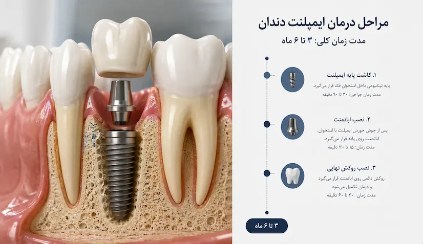 مدت زمان درمان ایمپلنت دندان